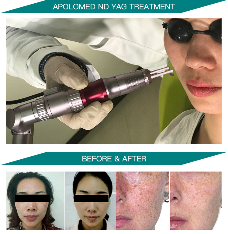 HS-298 ビフォーアフター写真