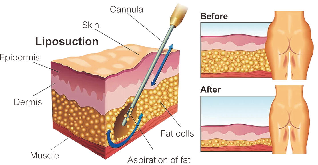 レーザー脂肪分解
