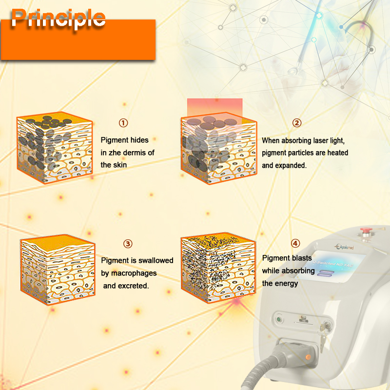 qスイッチタトゥー除去 