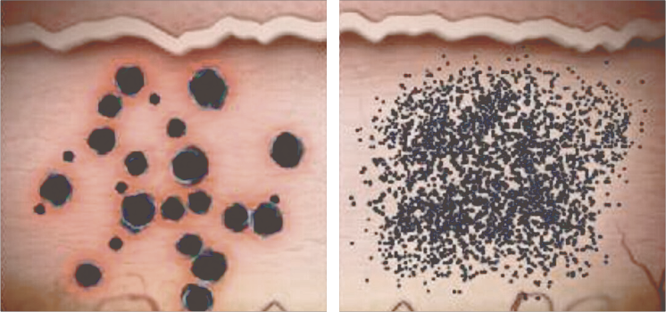 従来のレーザー