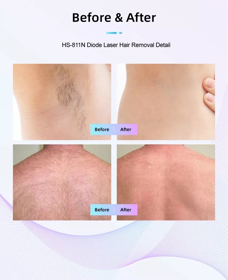 HS-811 ダイオード レーザー脱毛機工場