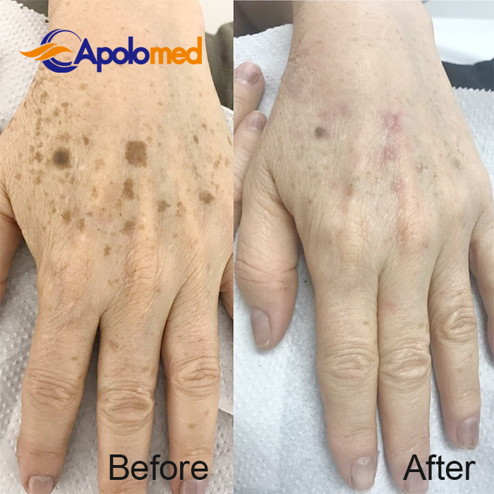 QスイッチNd YAGレーザー加工機 使用前 使用後