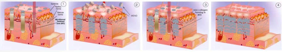 フラクショナルCO2レーザーの原理