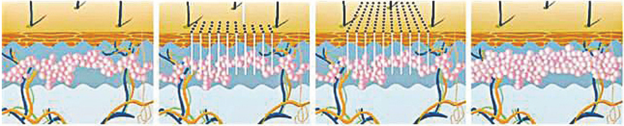 1550nmエルビウムファイバーレーザー---ディープリモデリング